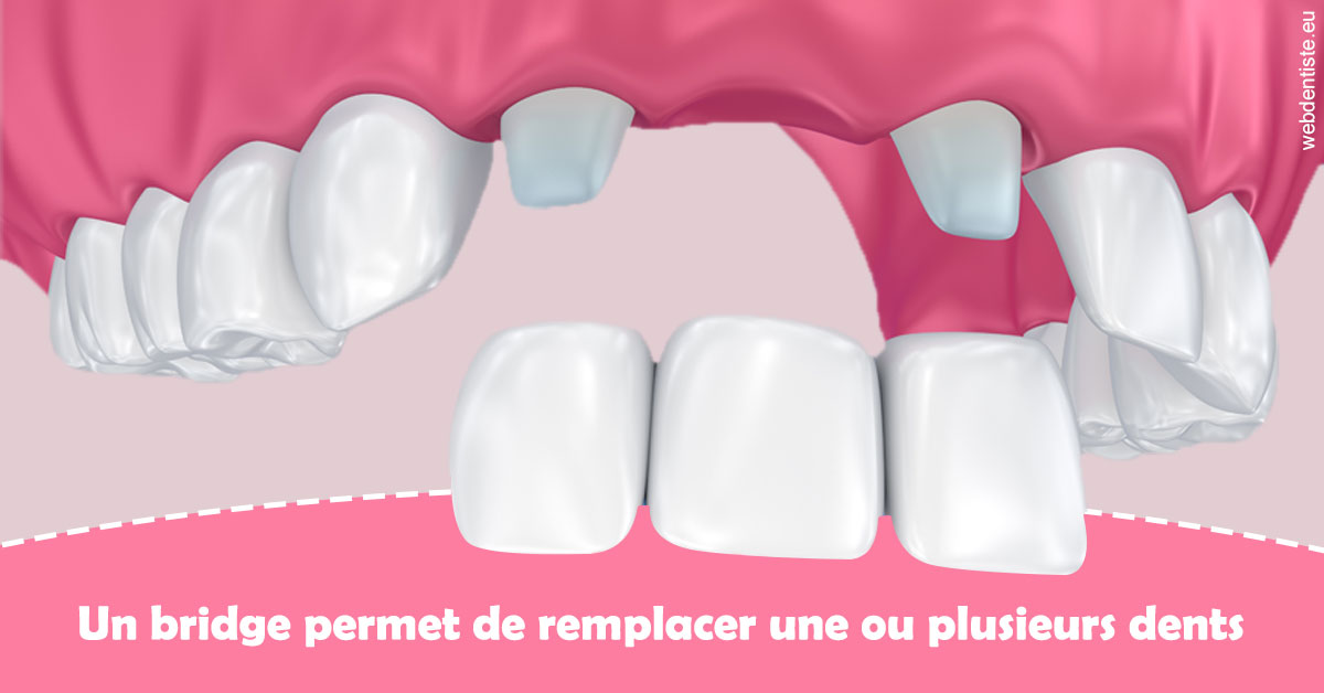 https://scp-jacques-et-elisabeth-topin.chirurgiens-dentistes.fr/Bridge remplacer dents 2