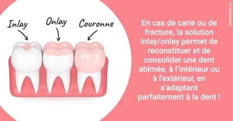 https://scp-jacques-et-elisabeth-topin.chirurgiens-dentistes.fr/L'INLAY ou l'ONLAY 2