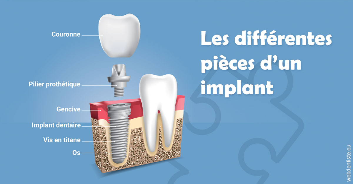 https://scp-jacques-et-elisabeth-topin.chirurgiens-dentistes.fr/Les différentes pièces d’un implant 1